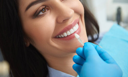 How Long Does Professional Teeth Whitening Last?