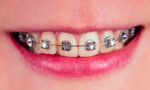 Life with Braces: Tips for Eating, Cleaning, and Comfort